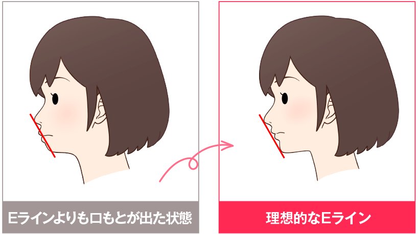 Ｅラインが整い横顔が綺麗に